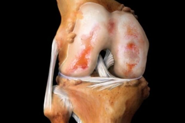 Artroz nedeniyle diz ekleminin tahrip edilmesi - kas-iskelet sisteminin yaygın bir patolojisi