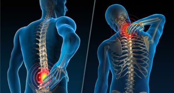 Osteokondroz gelişimini gösteren belirtiler - boyunda ve belde ağrı