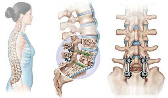 Osteokondrozun ileri evresinde yer değiştiren omurların implantlarla sabitlenmesi