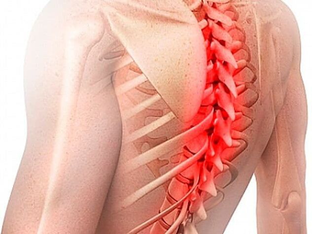 Torasik omurganın osteokondrozu hastalığın nadir bir şeklidir