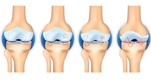 Osteorroz aşamaları