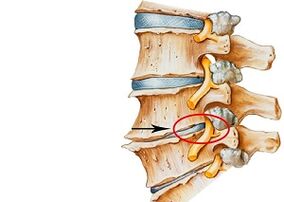 Servikal osteokondrozun nedenleri